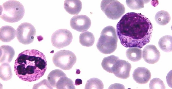 celulas-leucemia-wiki.jpg