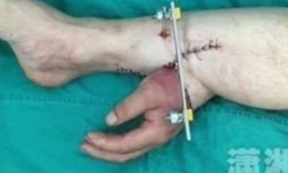 injerto-mano-pierna.jpg