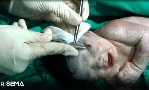 bebe-siria-metralla-frente-sema.jpg