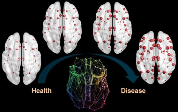 cerebro-alzheimer.jpg