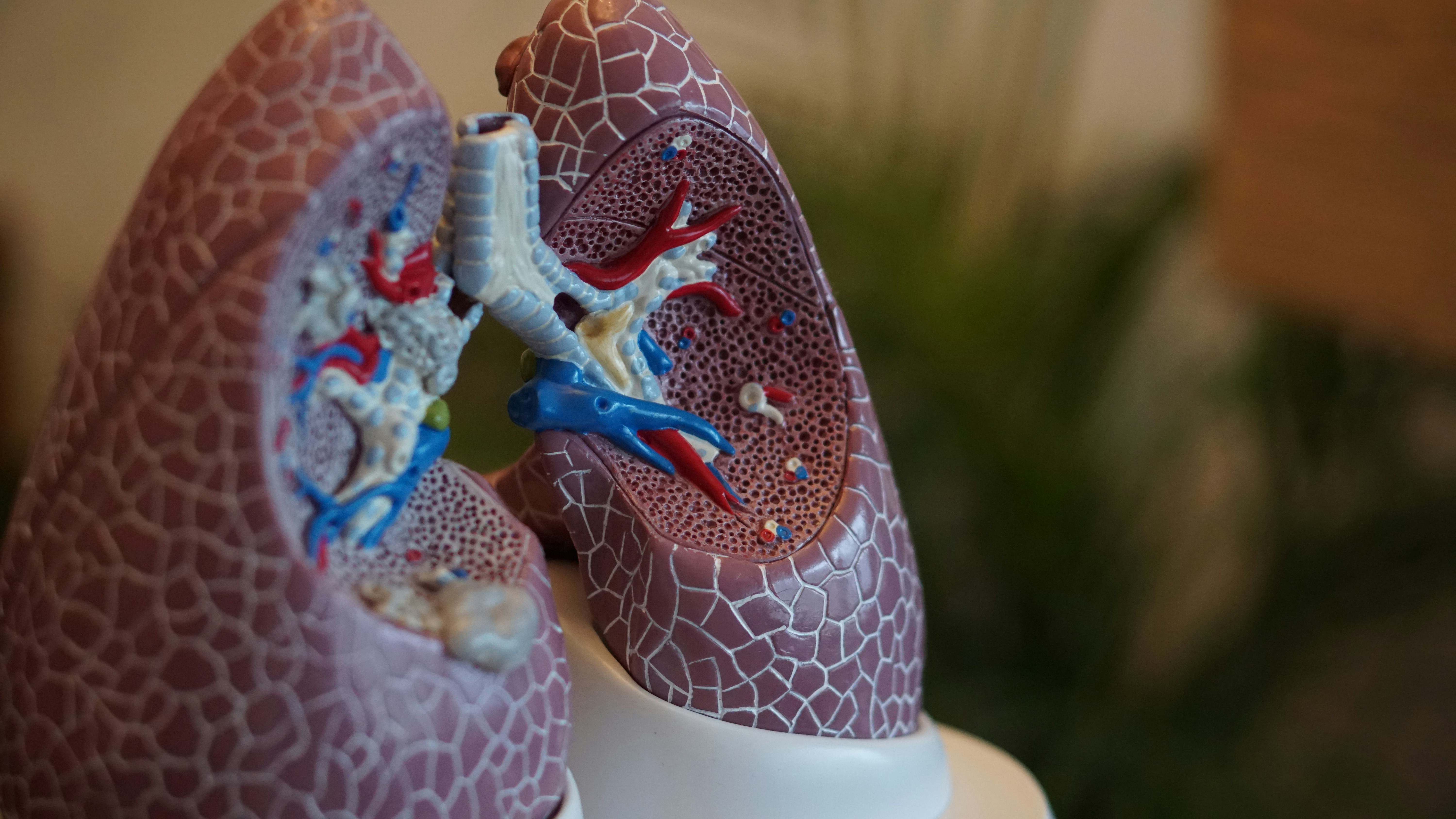 El cáncer de pulmón primario es un cáncer que se origina a partir de células pulmonares