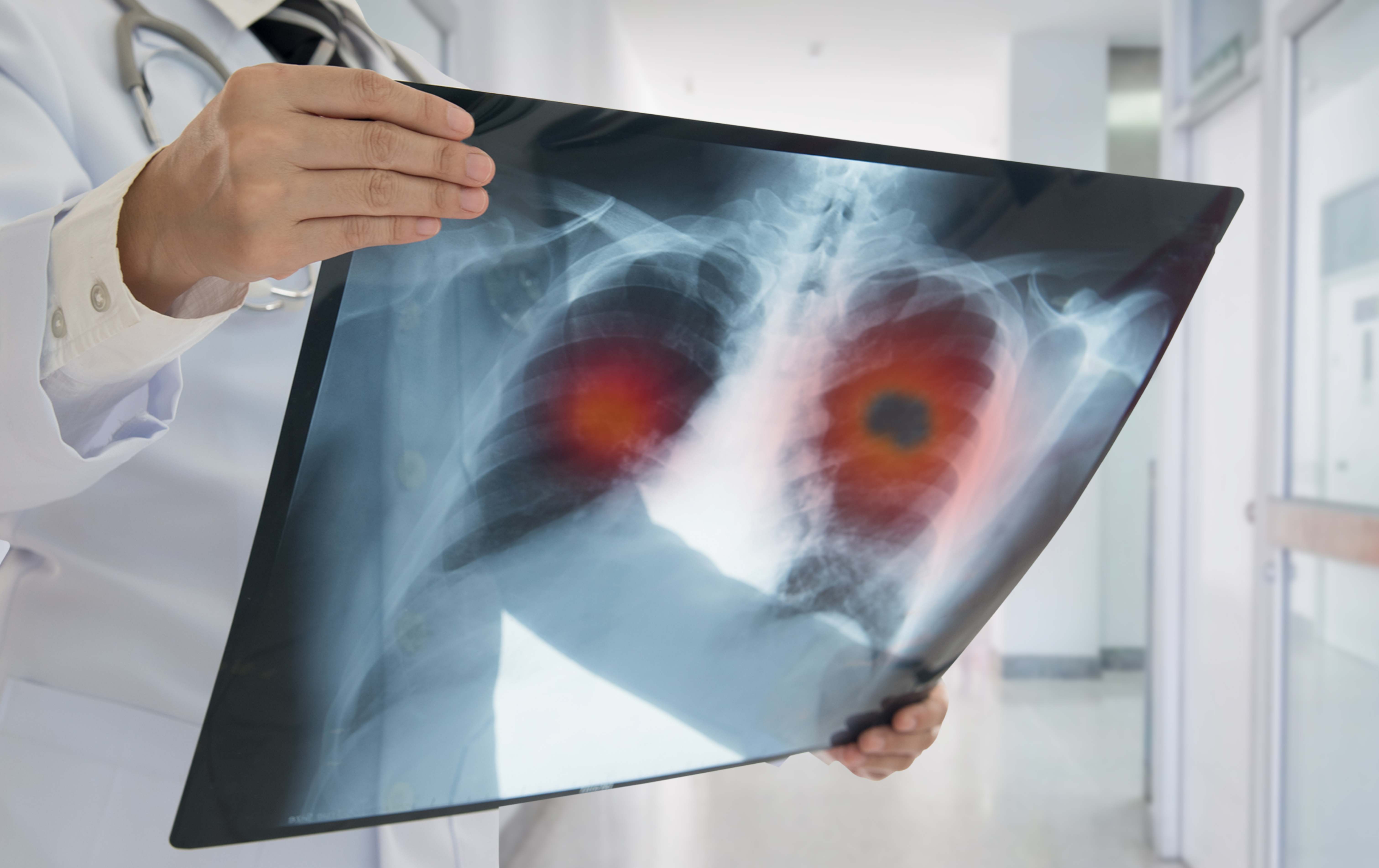 Pulmones