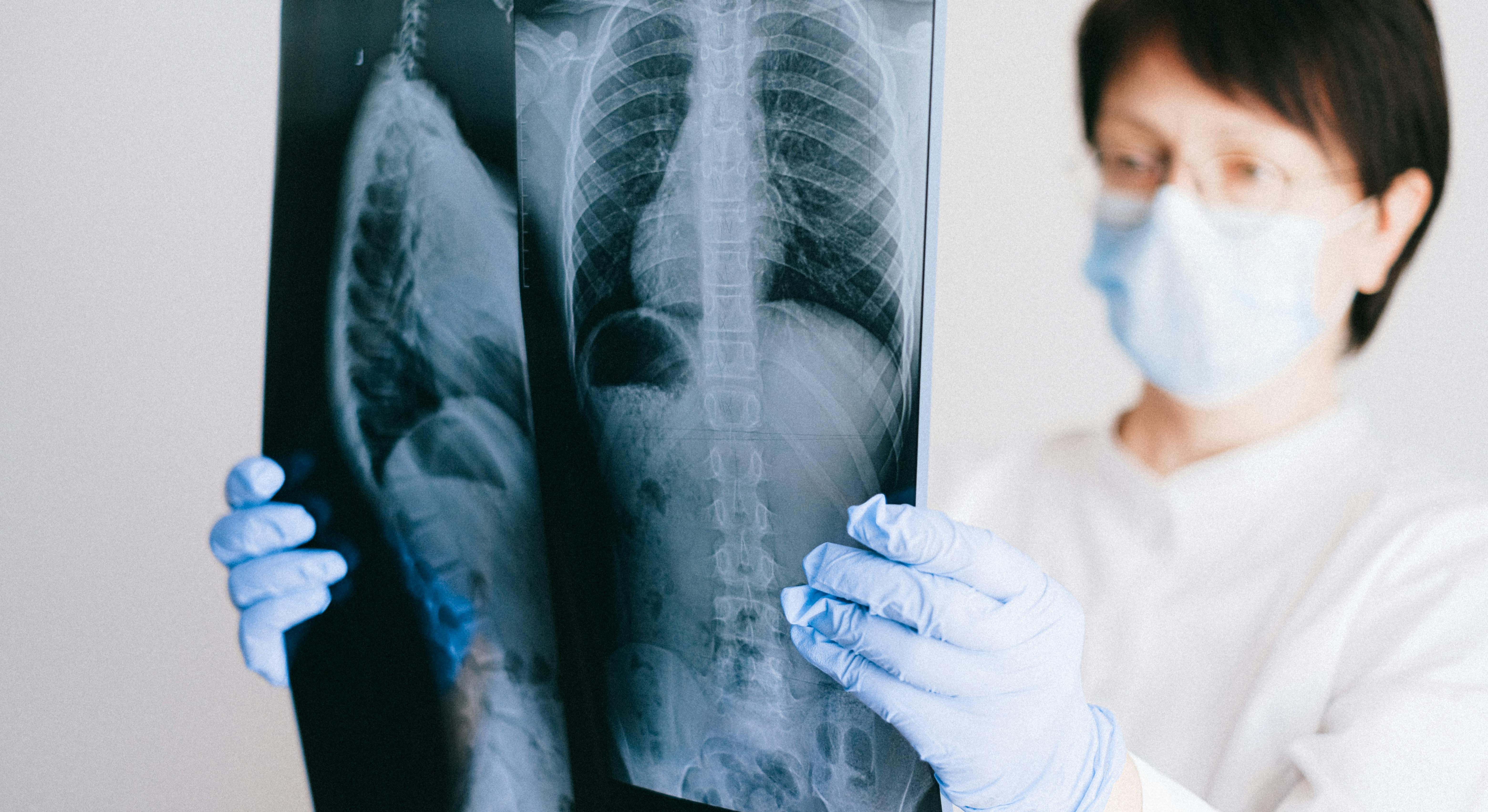 El cáncer pulmonar es un tipo de cáncer que se inicia en los pulmones