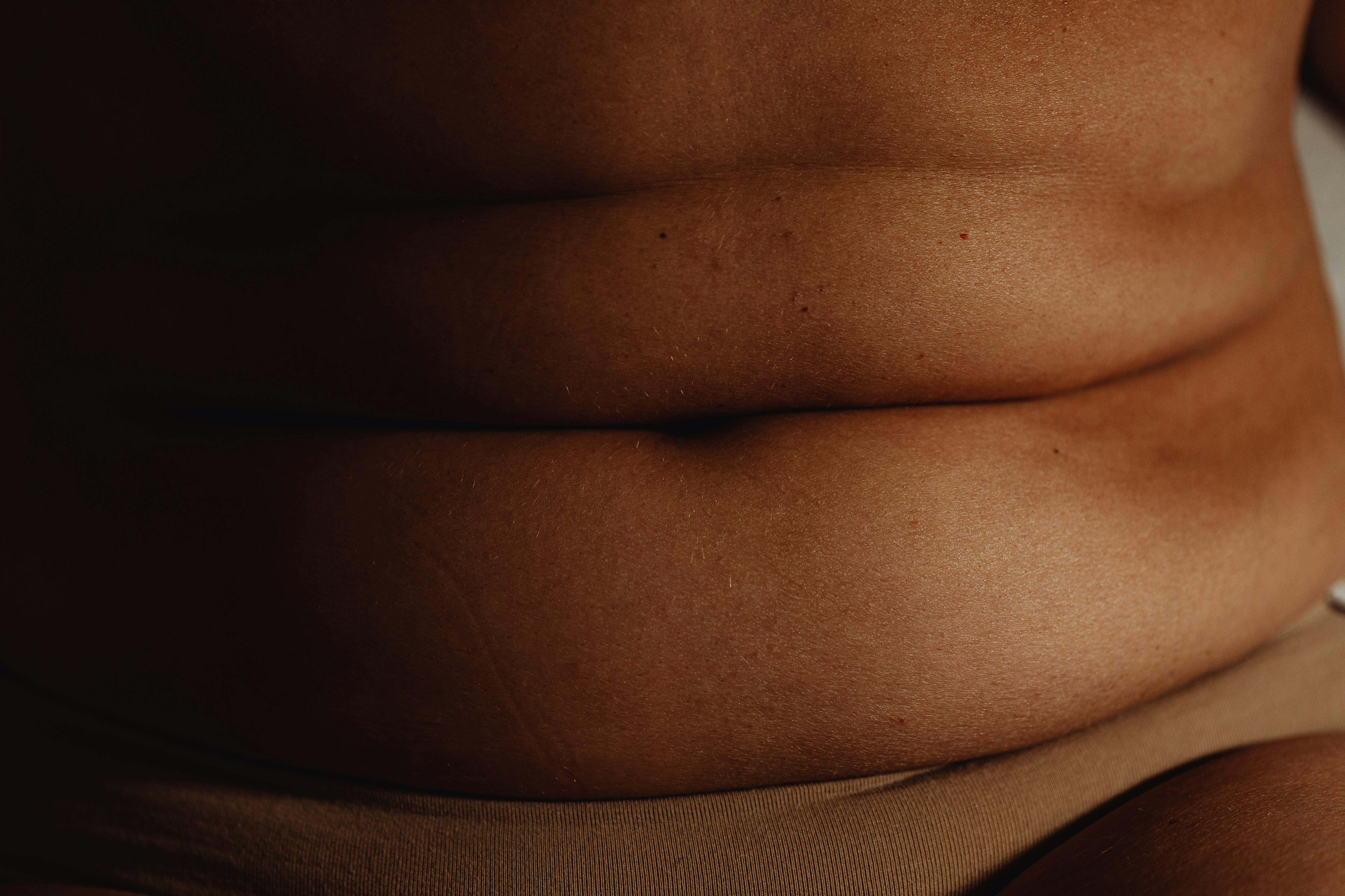 La obesidad no es solo un problema estético