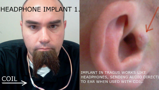 implante-auricular.jpg