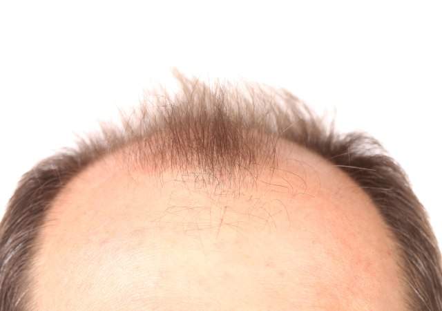 injerto-pelo-turquia-esapana-1.jpg