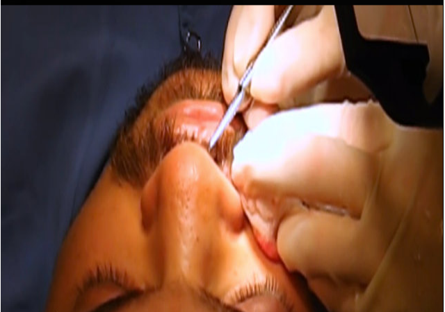 implantes-bigote.png