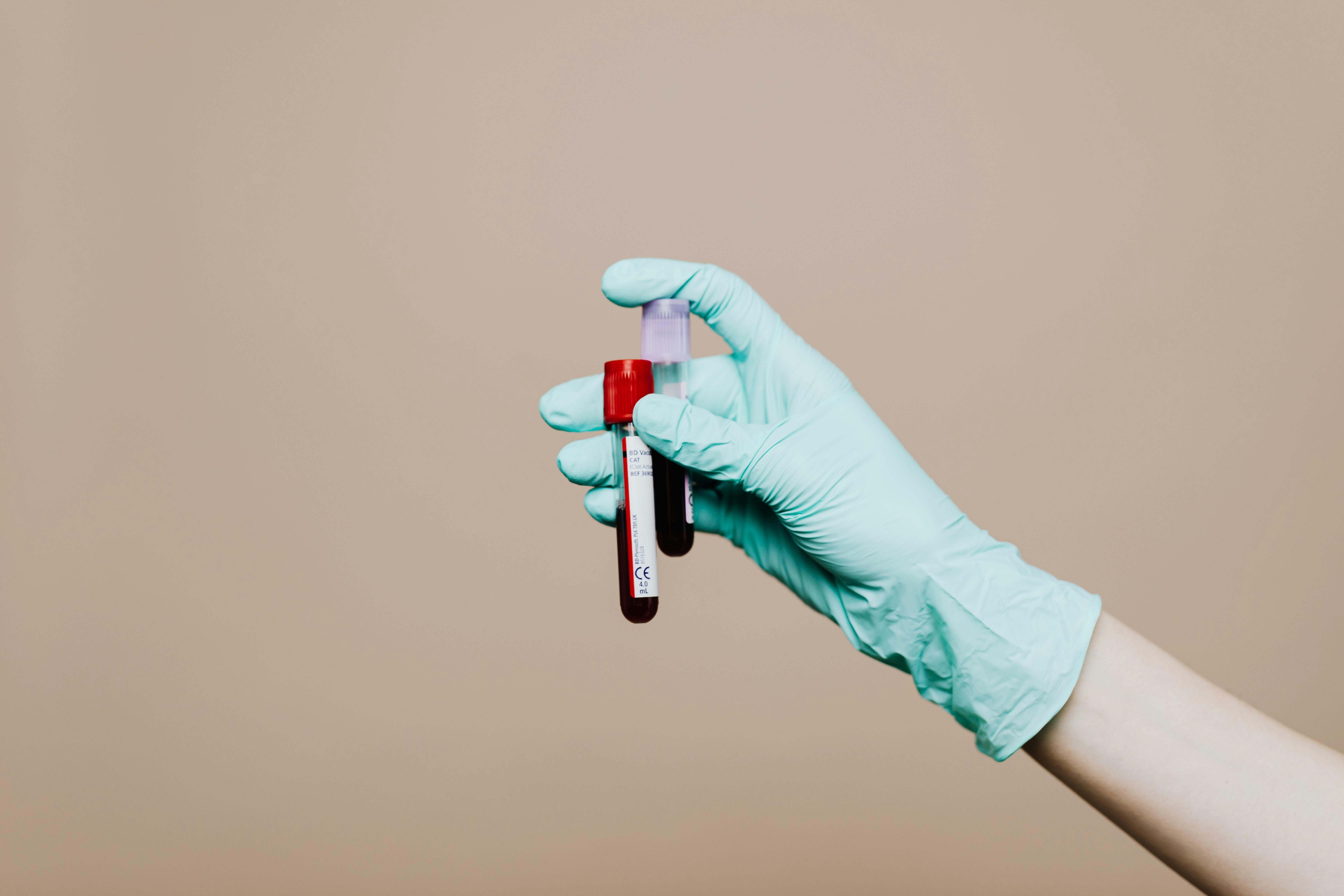 Las personas con hiperlipidemia tienen demasiados lípidos (grasas) en la sangre