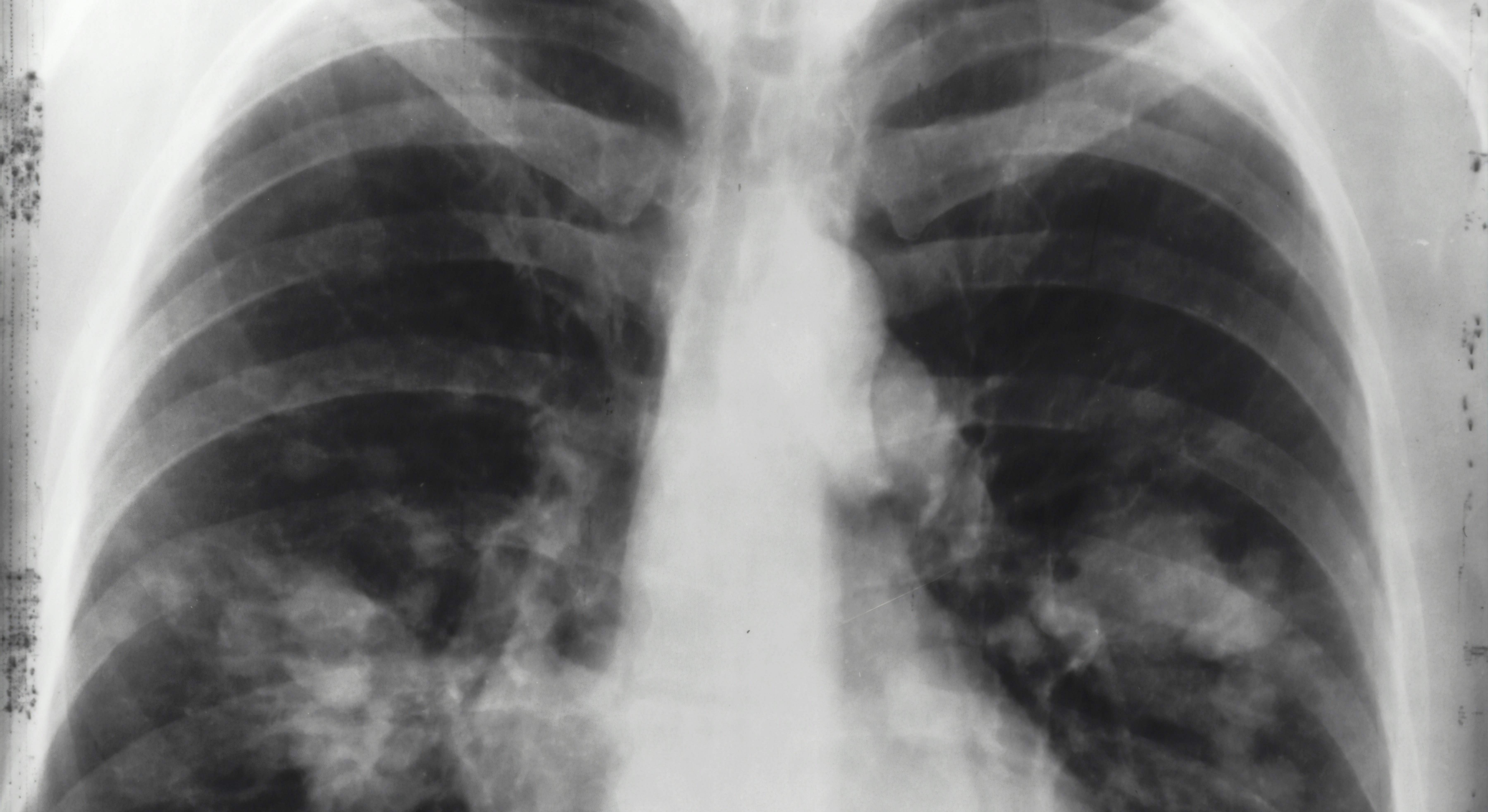 El cáncer de pulmón es un cáncer que se forma en los tejidos del pulmón