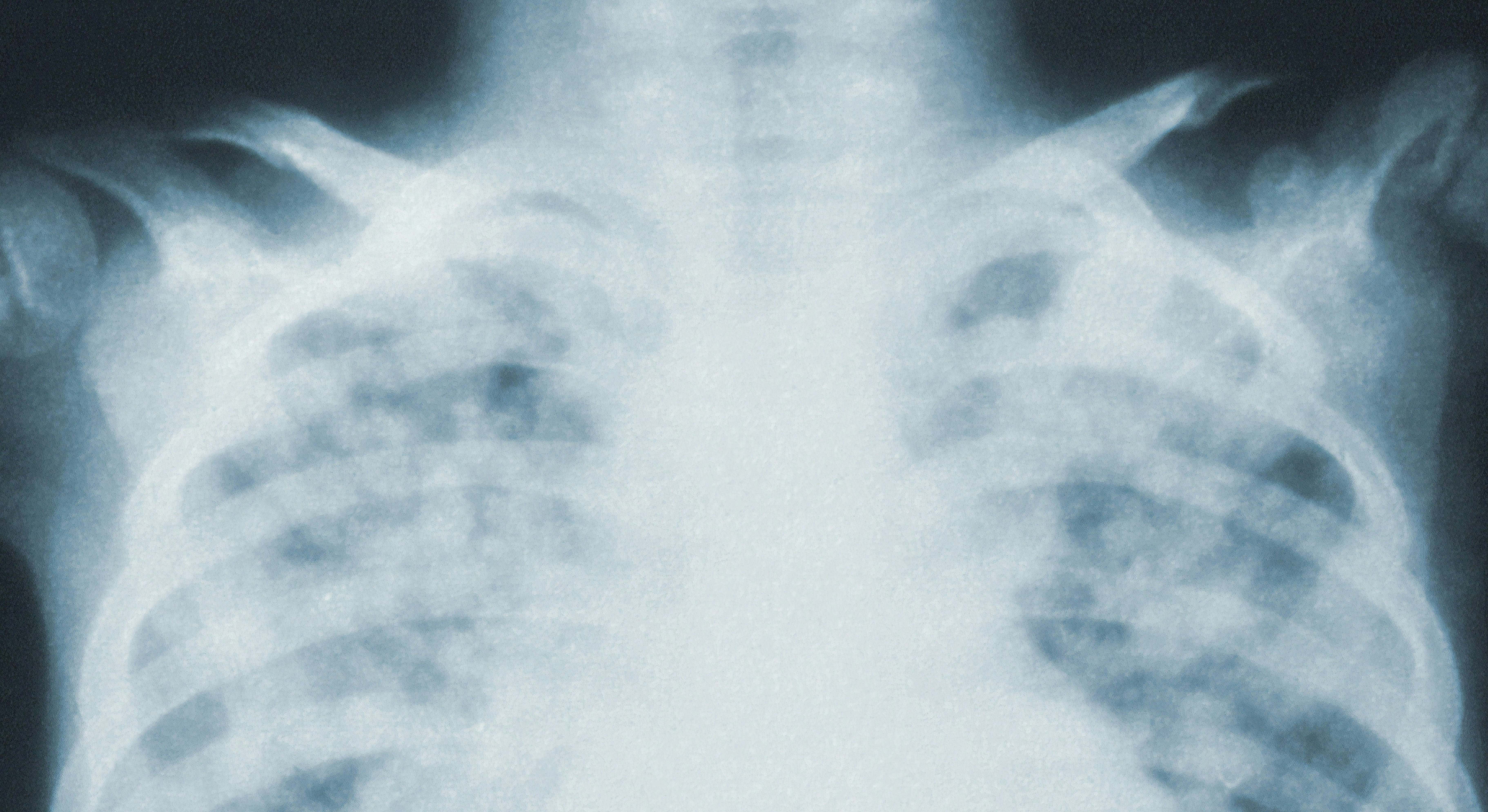 El cáncer pulmonar es un tipo de cáncer que se inicia en los pulmones