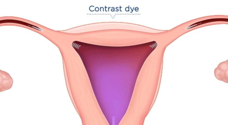 essure-trompas.jpg