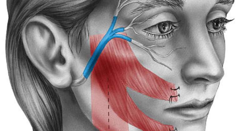 paralisis-facial-ilustracion-770.jpg