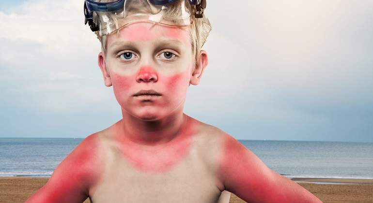 Nino-con-quemaduras-por-el-sol-iStock.jpg