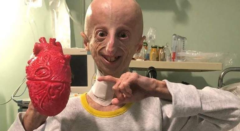 Golpe a la progeria: científicos españoles logran avances en la enfermedad que convierte a los niños en ancianos