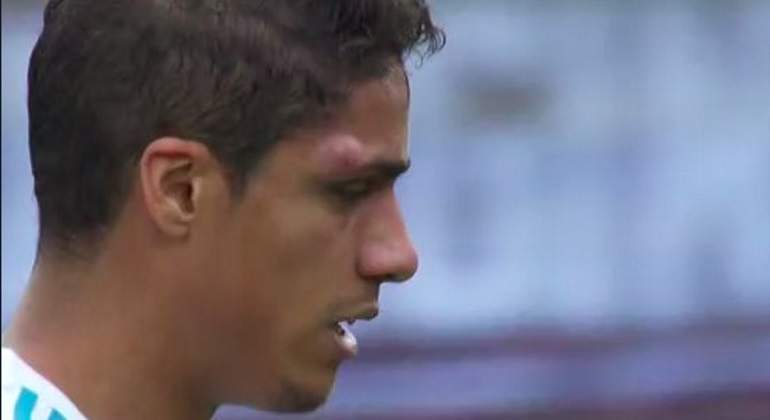 varane-chichon.jpg