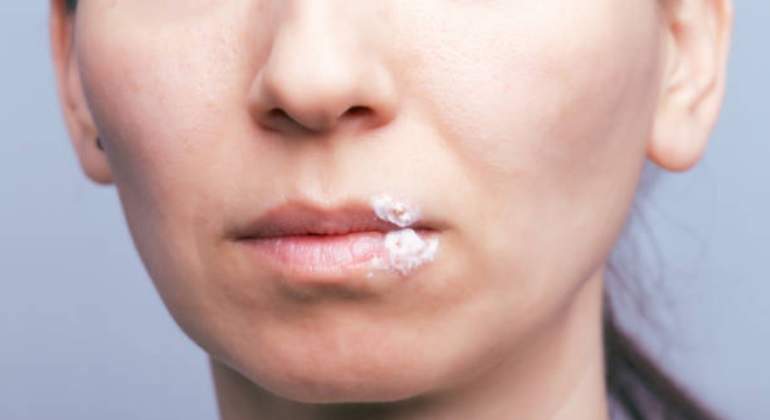 Herpes-labial-istock-770.jpg