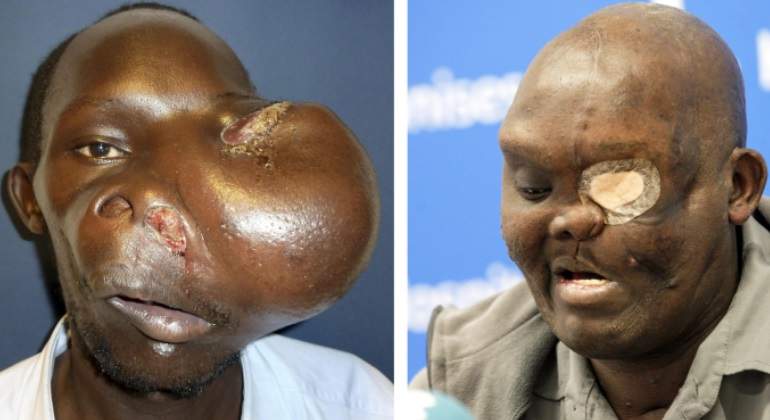 tumor-cavadas-kenya-cara-efe.jpg