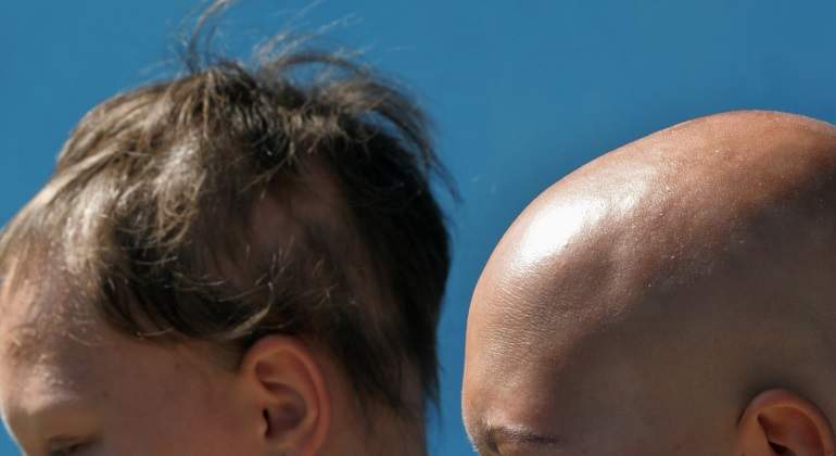 Alopecia-reuters.jpg