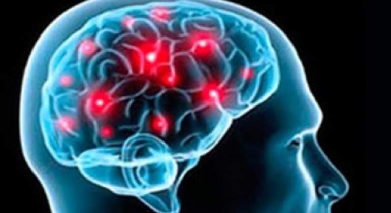 Infarto-cerebral-notimex-770.jpg