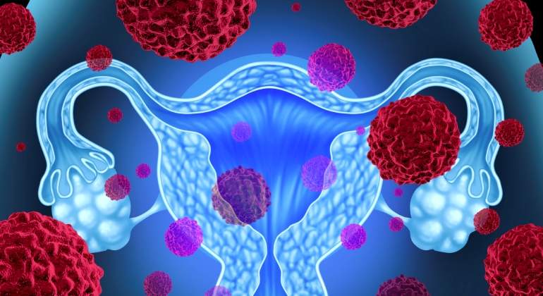 ovario-utero-cancer-istock.jpg
