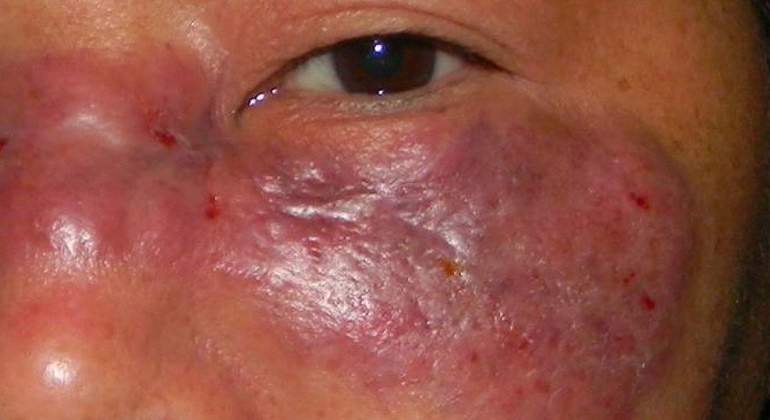 hongo-negro-infeccion-coronavirus-covid-19-india-Ran-Yuping.jpg