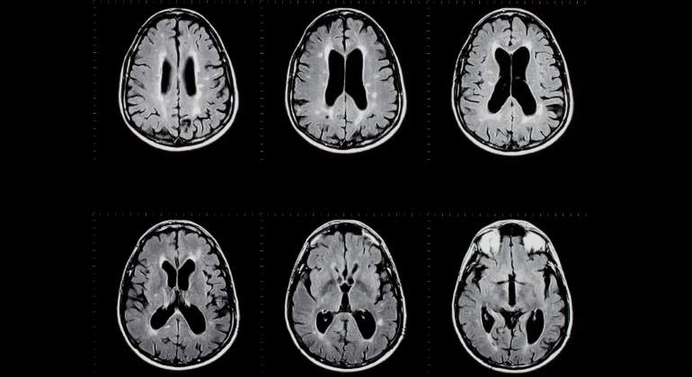 cerebro-esclerosis-multiple-dreamstime.jpg