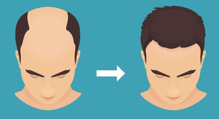 injerto-capilar-tecnica-fue-minoxidil-calvo-espana.jpg