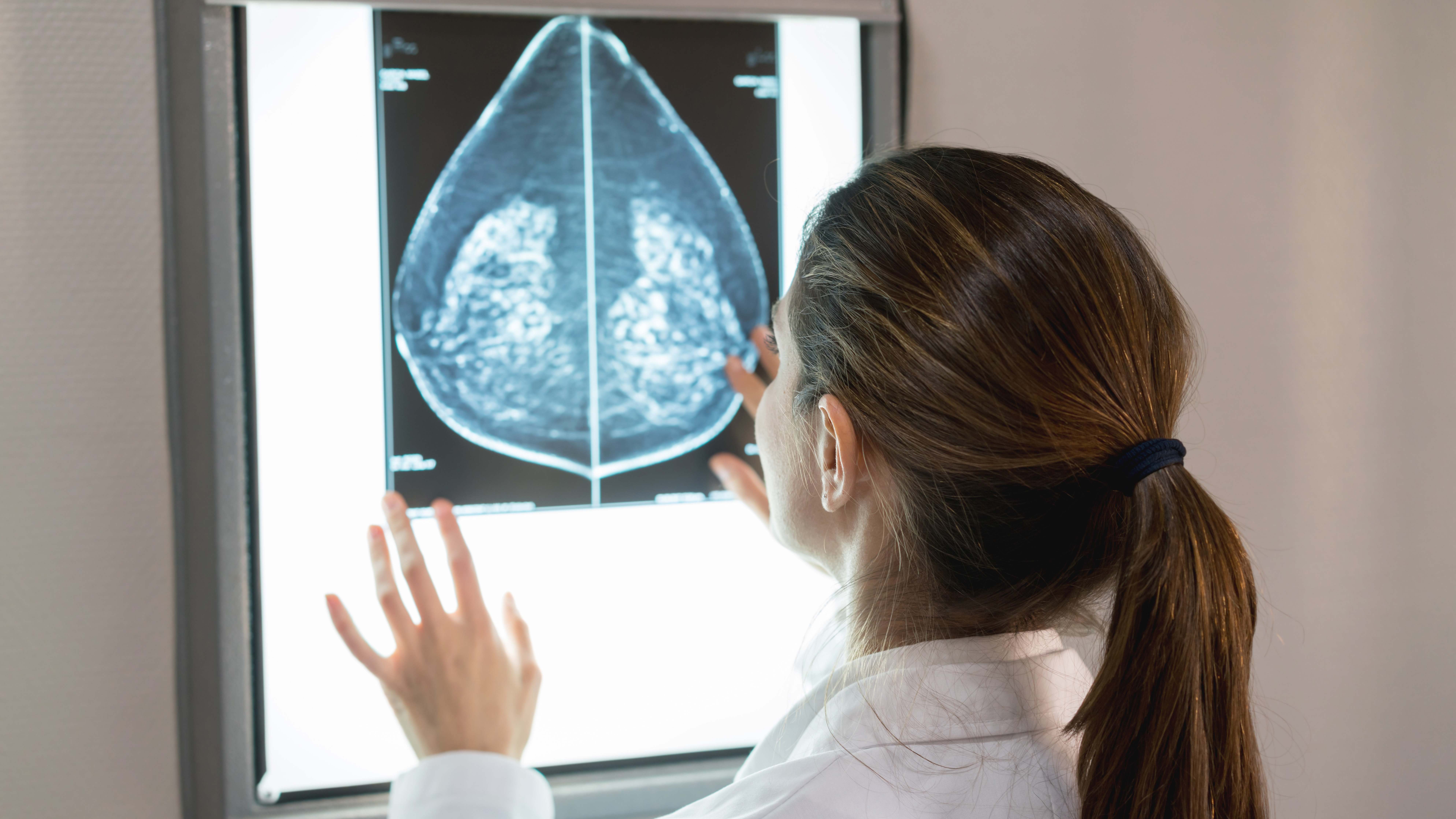 Mamografía para la detección del cáncer de mama. / Foto: iStock