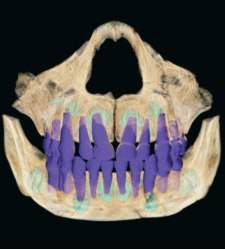 caries_neandertal.jpg