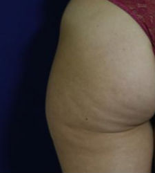 celulitis.jpg