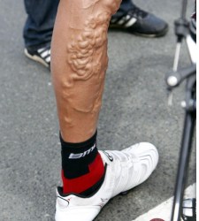 Hincapie-varices.jpg